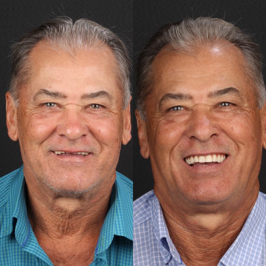 Antes e depois de implante dentário