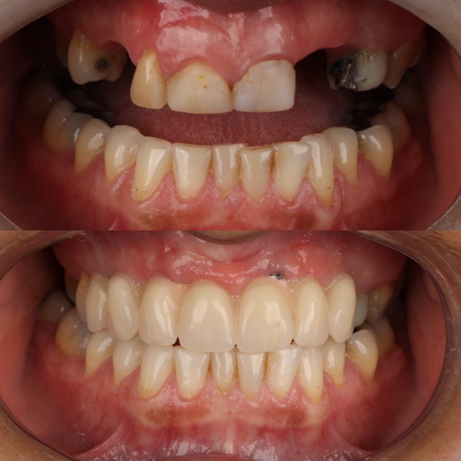 Antes e depois de implante dentário